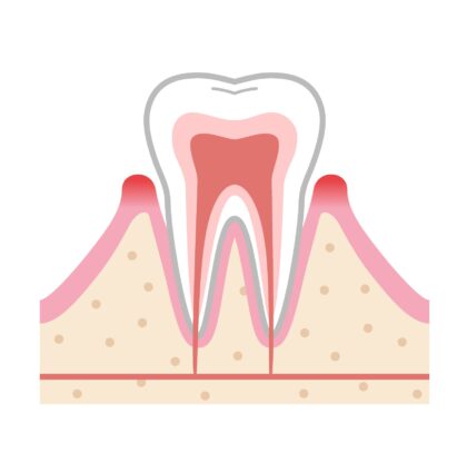 軽度歯周炎
