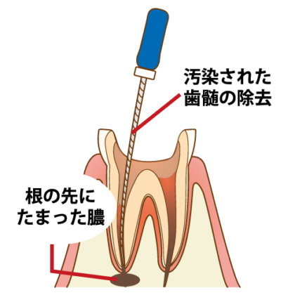 可能な限り歯を残すための「根管治療」