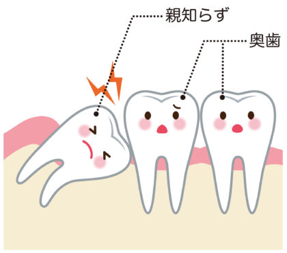 抜いた方がいい親知らず