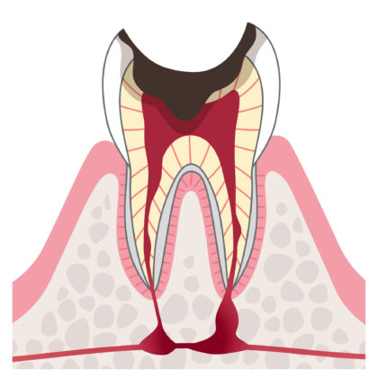 C4歯根に達したむし歯