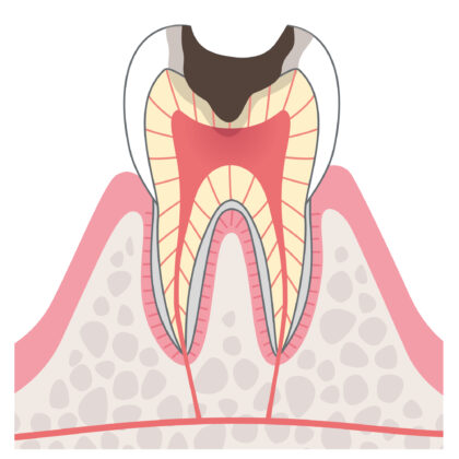 C3神経に達したむし歯