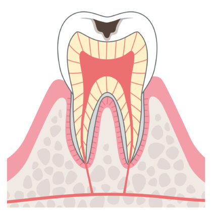 C2象牙質のむし歯