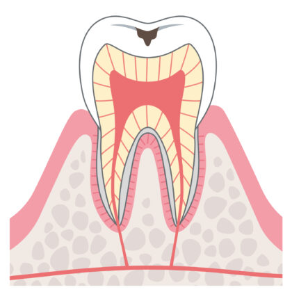 C1エナメル質のむし歯