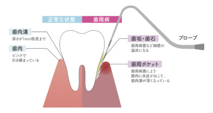 歯周病